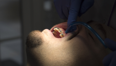 Ortodoncia en Adultos